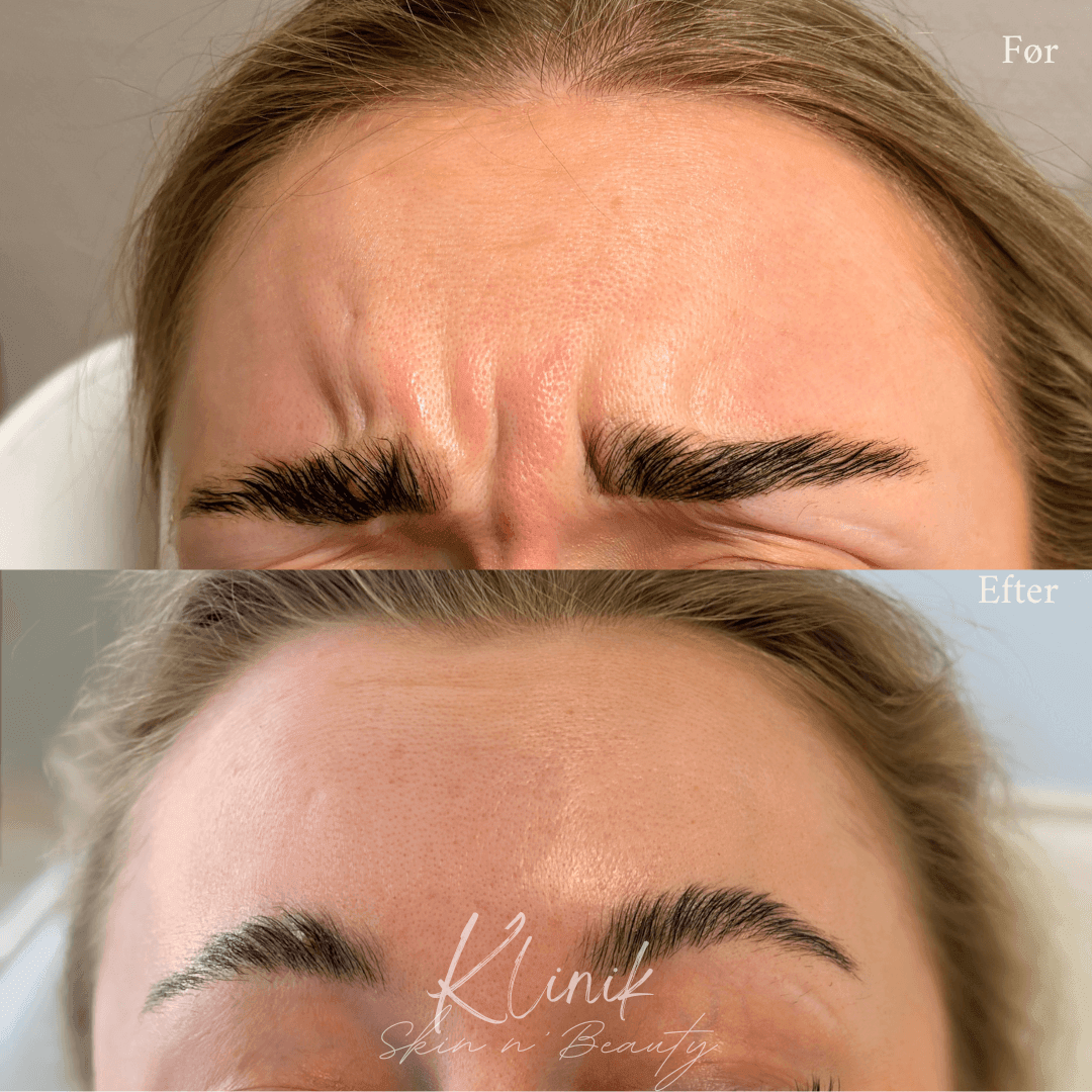 Botox før/efter