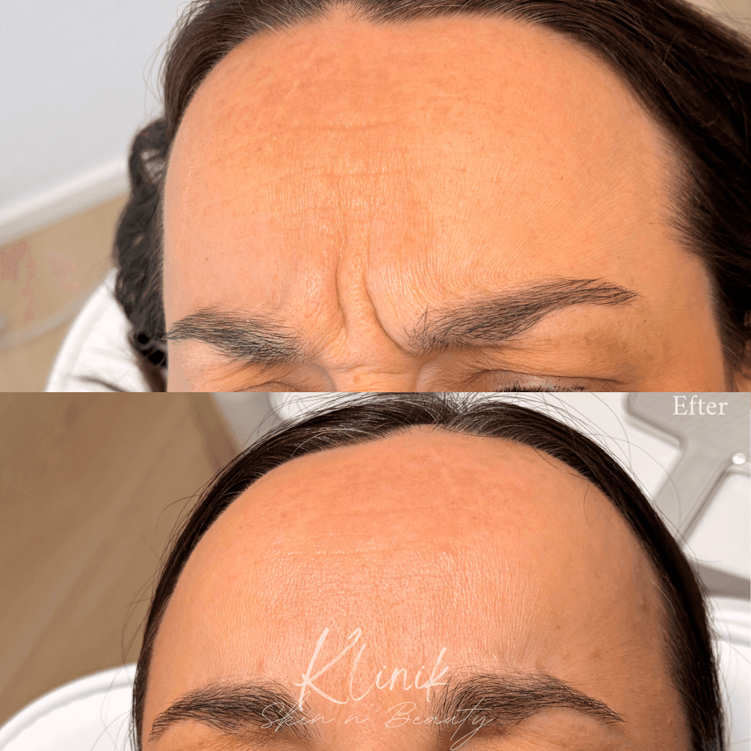 Botox før/efter