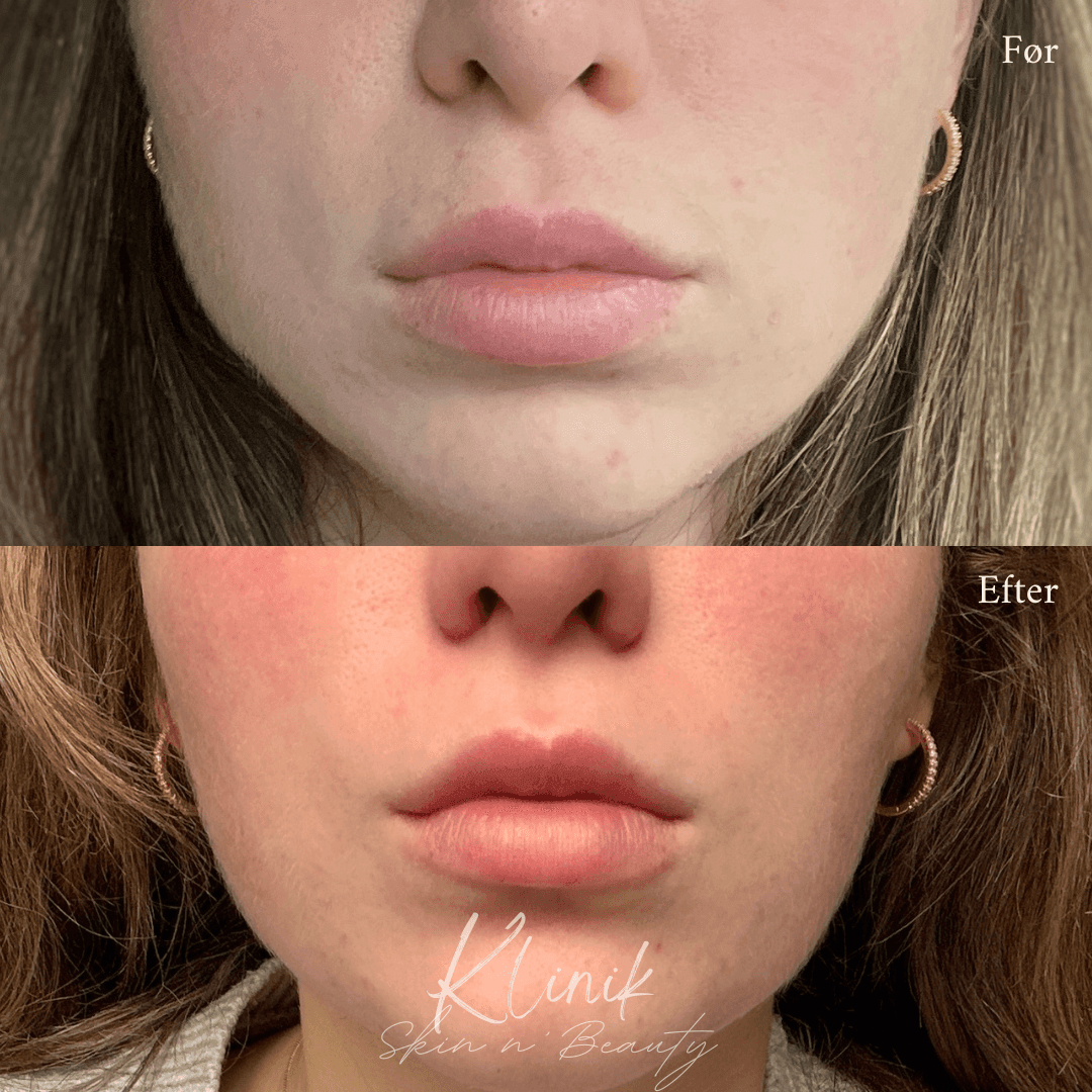 Botox/Filler før/efter