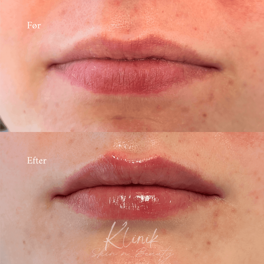 Læbefiller 0,5 ml