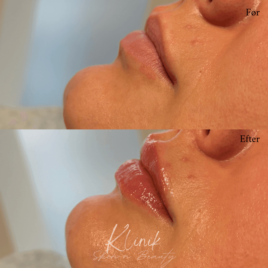 Læbefiller 0,5 ml
