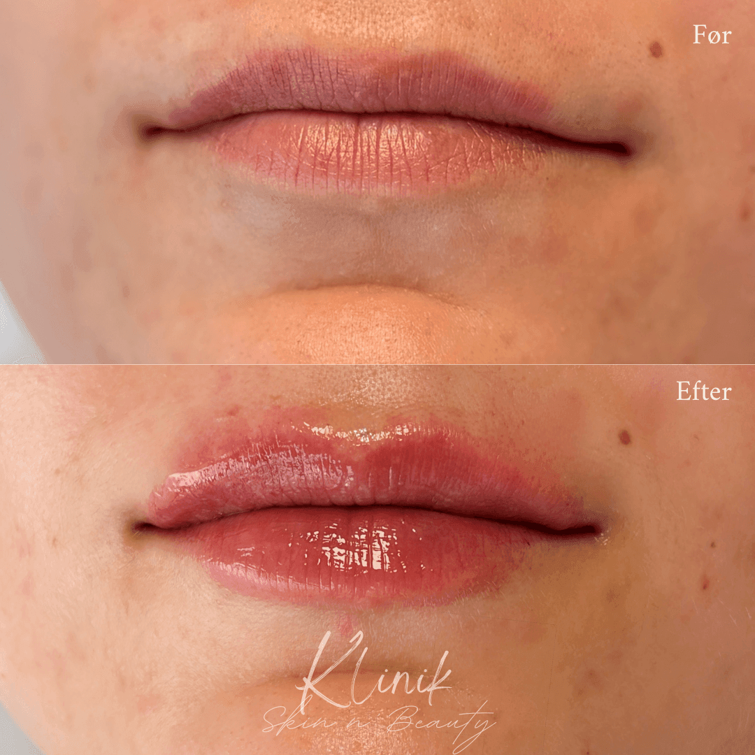 Læbefiller 0,5 ml