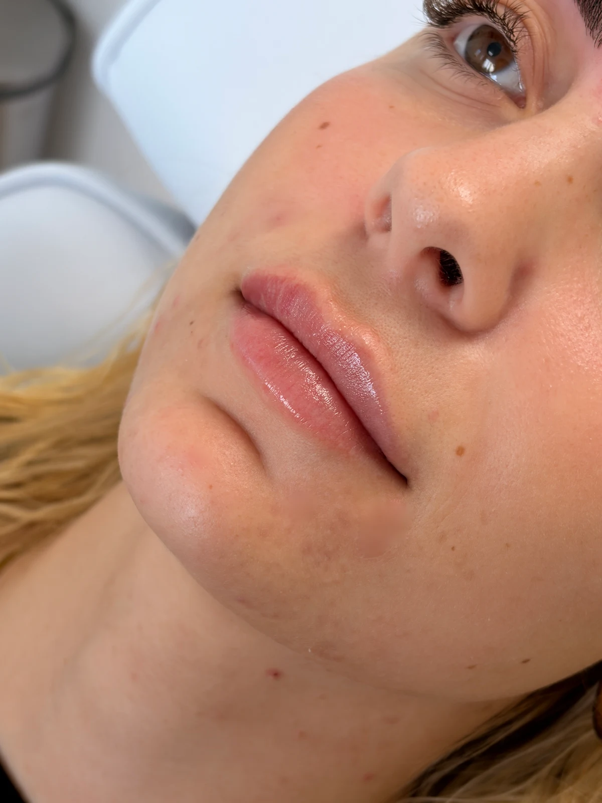Nærbillede af læber fra klinikkens udvalgte behandlingsfotos