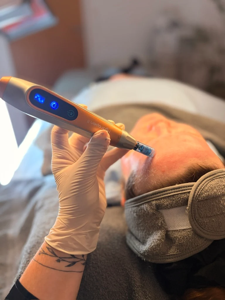 Microneedling udføres på kinden i klinikken
