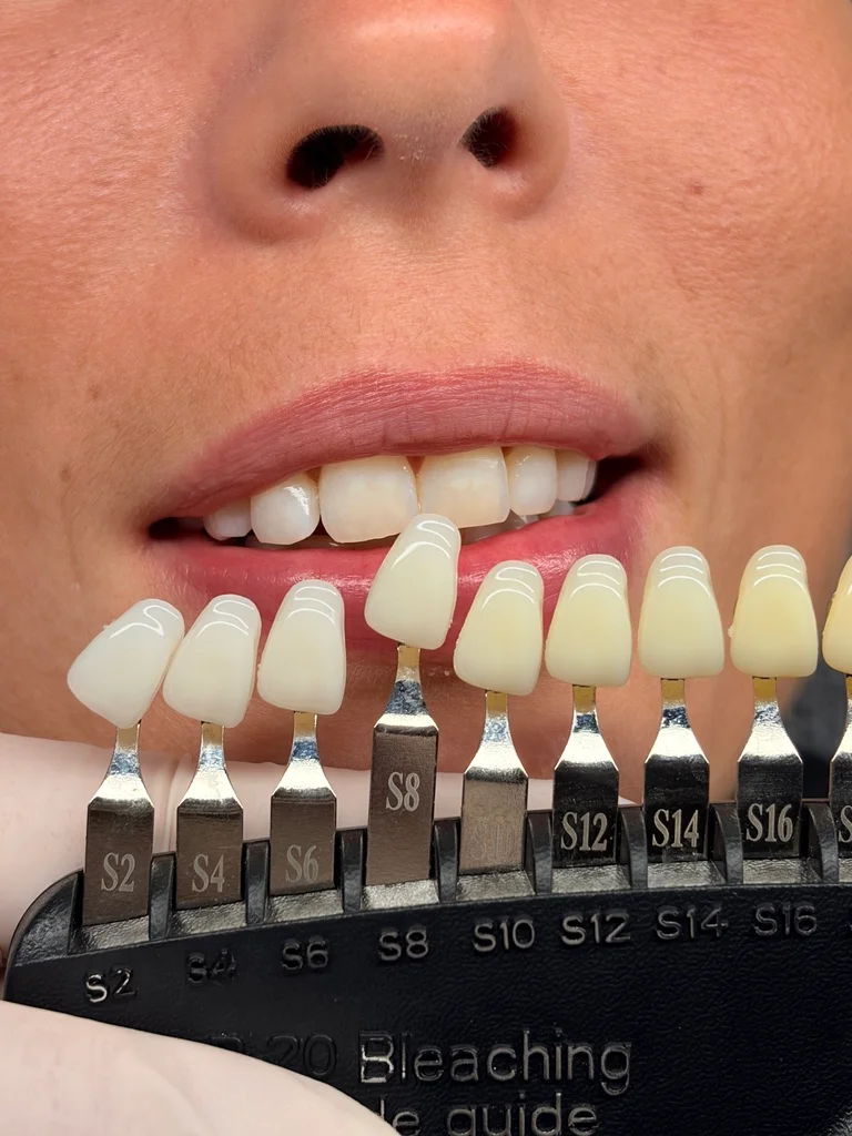 Smil og tandfarveskala fra klinikkens udvalgte fotos