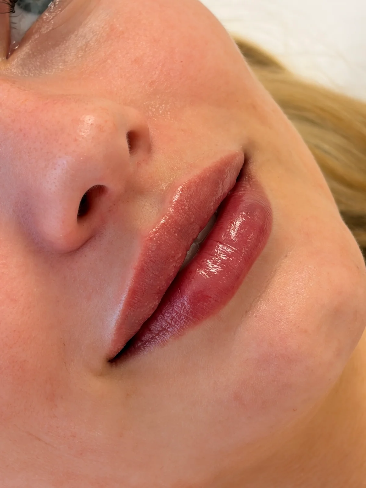 Nærbillede af læber fra klinikkens fillerfotos