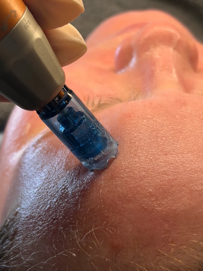Nærbillede af microneedling på kinden